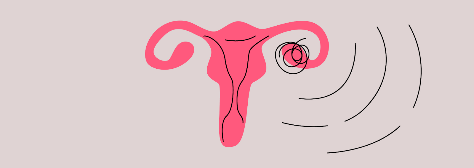 Single Ovary and Pregnancy – Everything You Should Know