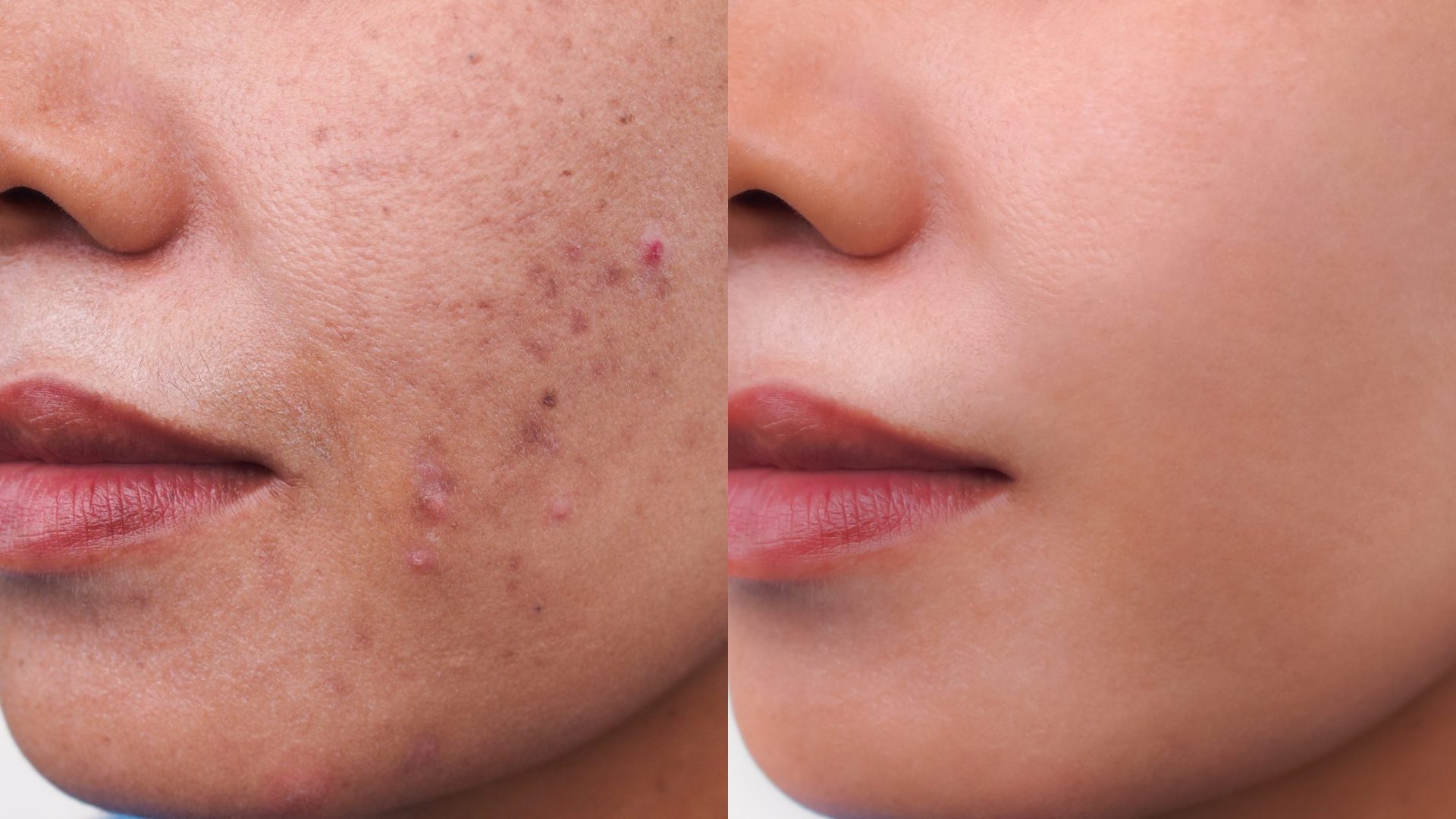 Hyperpigmentation treatment in the best way permanently