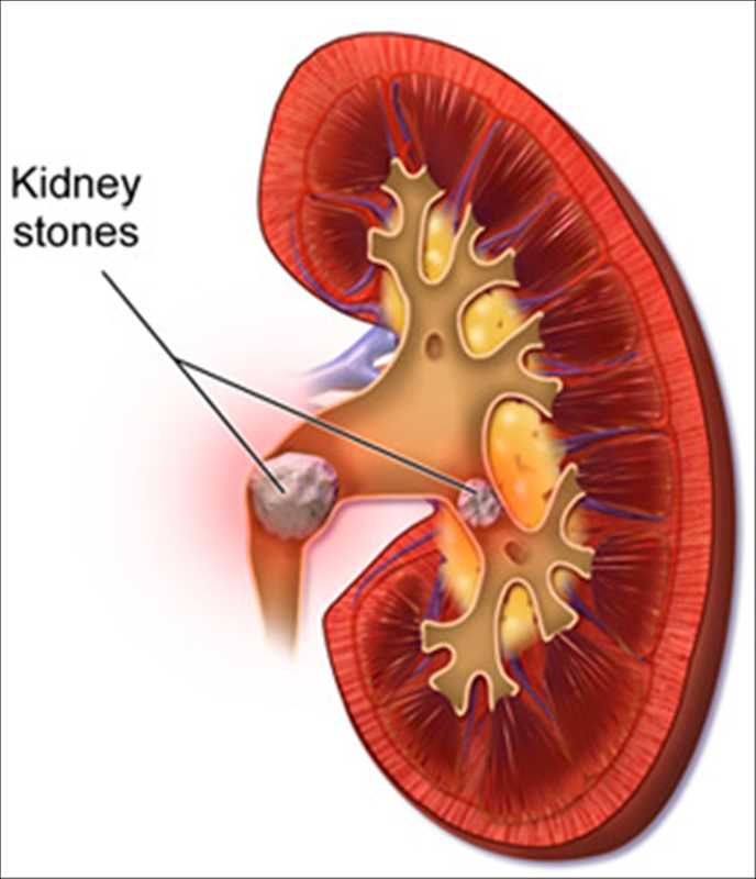 Global Kidney Stone Management Market by Size, Trends, and Demand