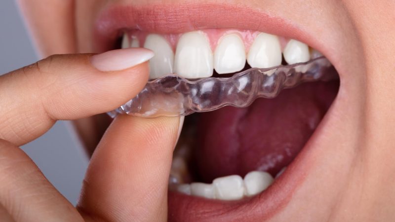 What You Need To Know About Getting Invisalign From A Dentist?