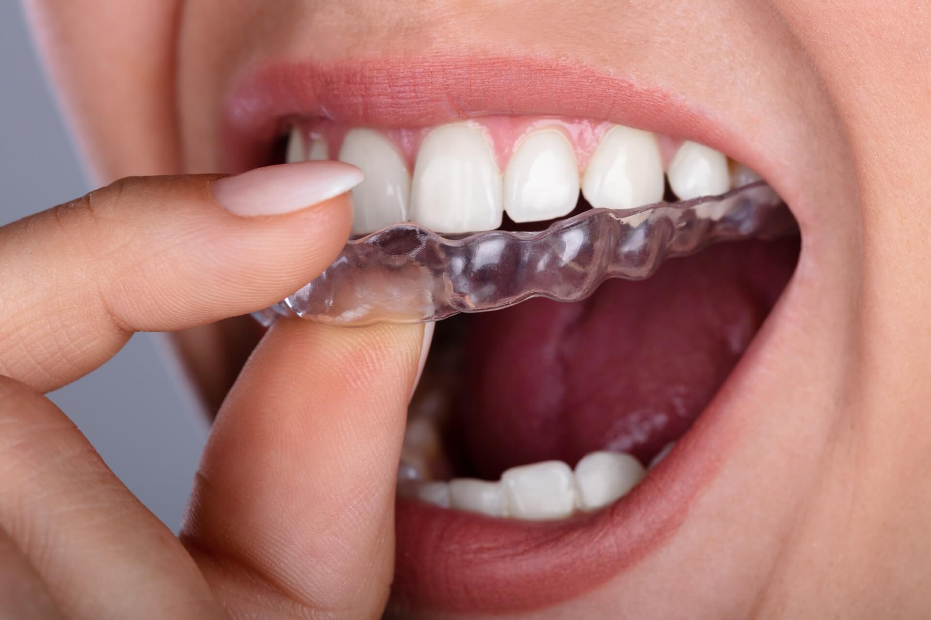 What You Need To Know About Getting Invisalign From A Dentist?