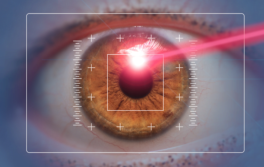 FAQs on contoura vision lasik surgery 